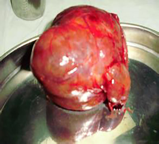 胸骨後甲狀腺瘤的變現