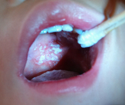 寶寶鵝口瘡 (72) 