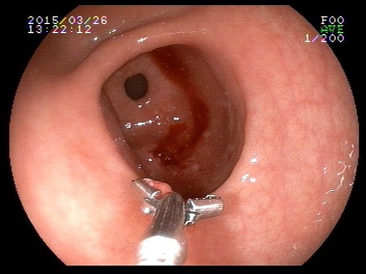 食道炎症狀 (49) 