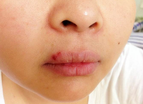 嘴唇潰瘍
