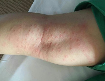 身體蟎蟲過敏症狀