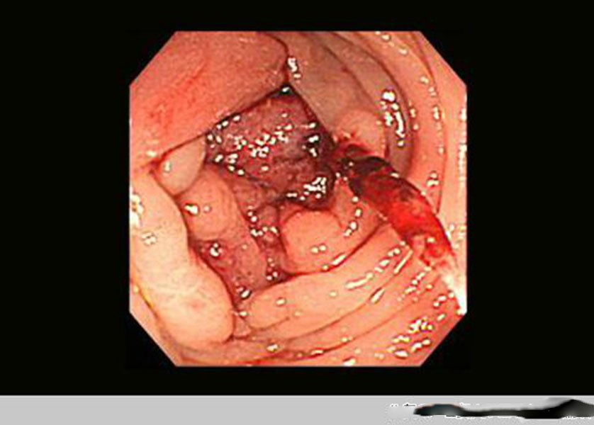 直腸腫瘤報告單