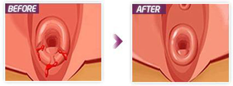 處女膜片整形圖 