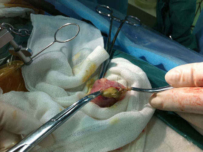 手術後巧克力囊腫