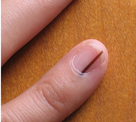 手指甲上有豎紋圖解 (5) 