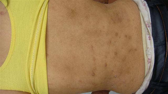 結節性癢疹 (50) 