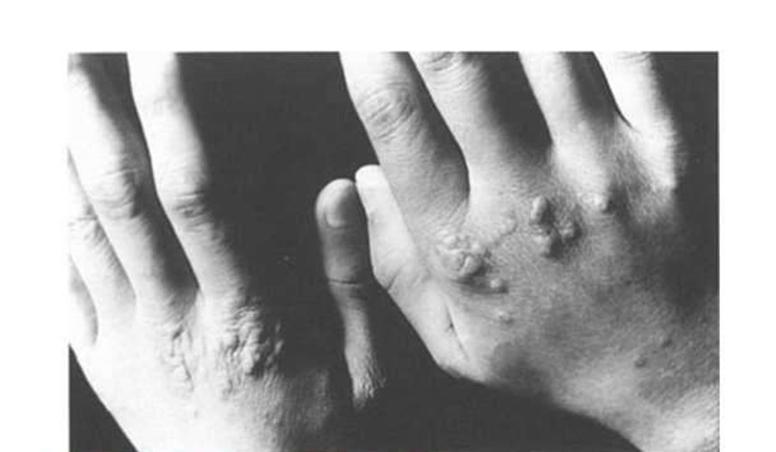 傳染性軟疣怎麼治 