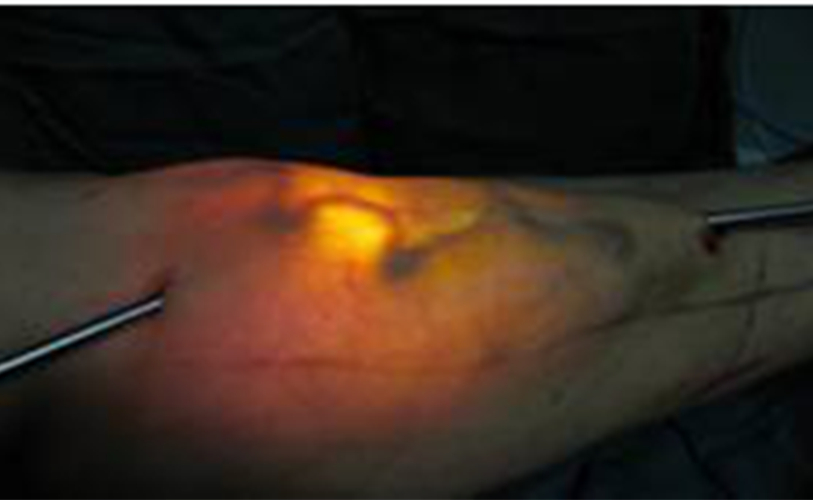 治療下肢血栓性淺靜脈炎