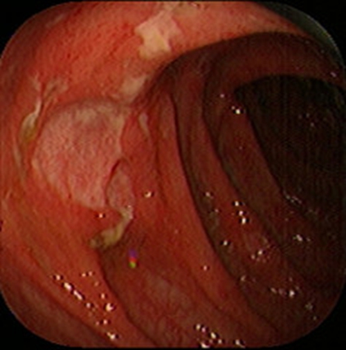 急性胃炎陽性的表現