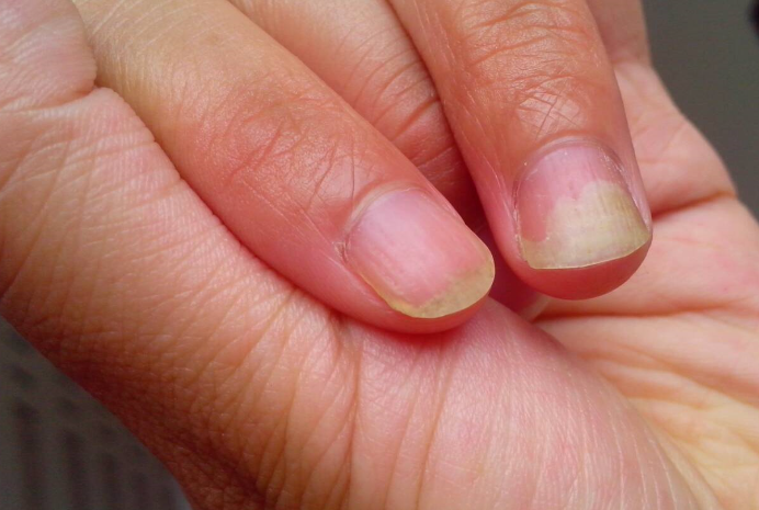 貧血指甲