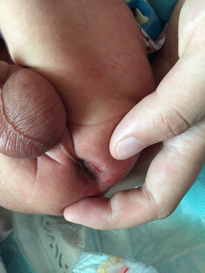嬰兒肛周膿腫 (13) 