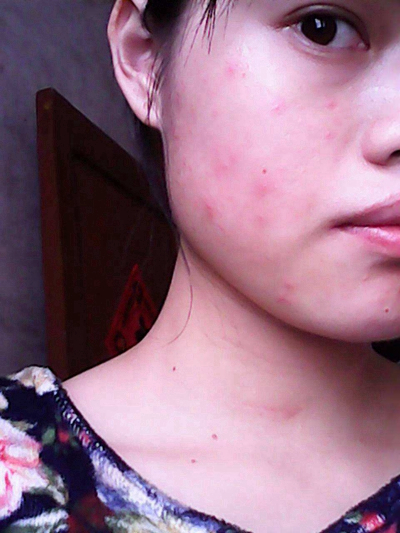 神經性皮炎的治療 (57) 