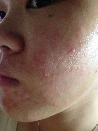 血熱的症狀痘痘