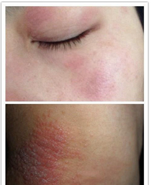 臉部接觸性皮炎