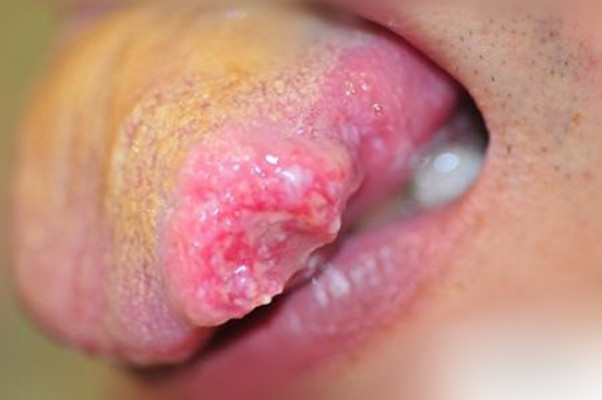 口腔癌的前兆 (46) 