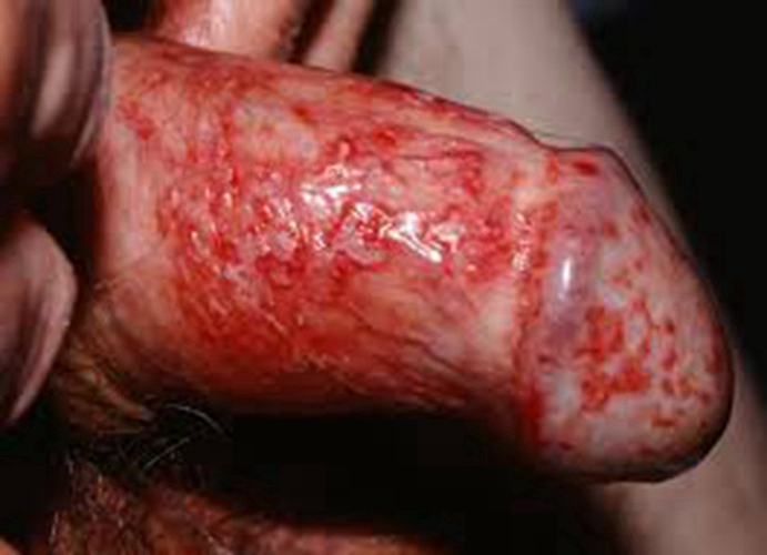 環狀潰爛性包皮龜頭炎的