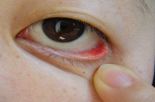 眼睛麥粒腫初期