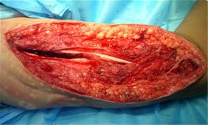 後期骨髓炎醫治