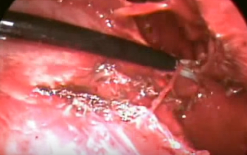 結核性胸膜炎胸腔積液