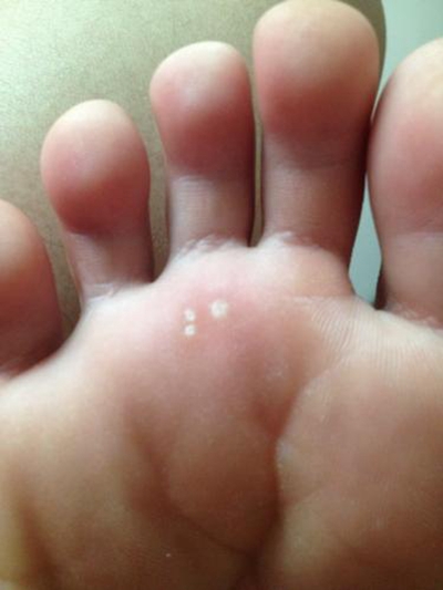 腳底蹠疣早期