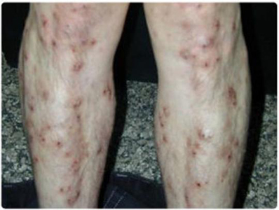 結節性癢疹 (43) 