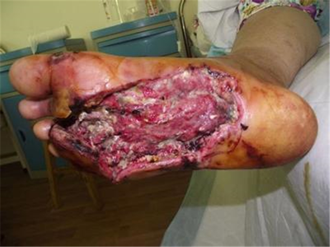 糖尿病足足底潰爛