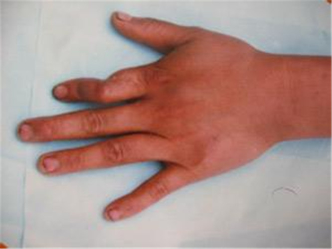 早期骨髓炎醫治