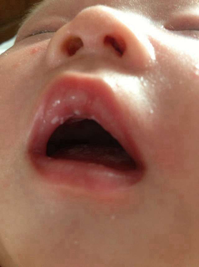 寶寶鵝口瘡 (77) 