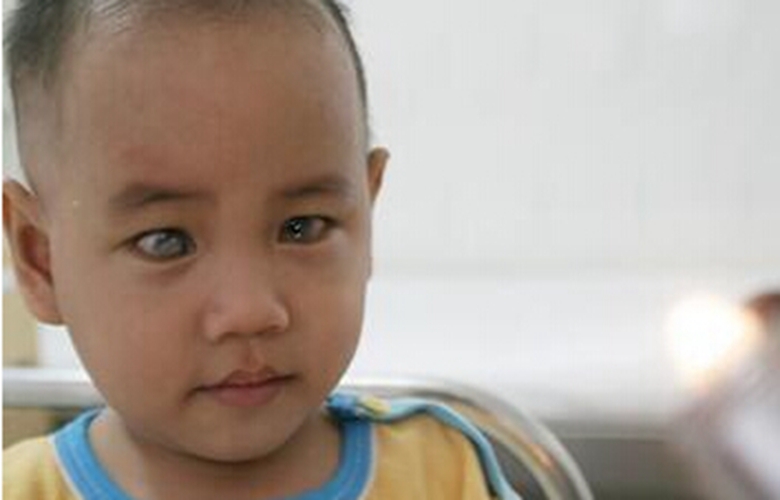 小兒青光眼的症狀