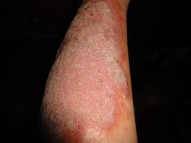 腿部的放射性皮炎