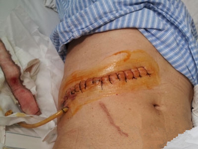 腎腫瘤轉移肺腺癌症狀