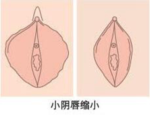 陰唇肥大手術後