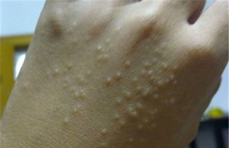 水泡手部溼疹的