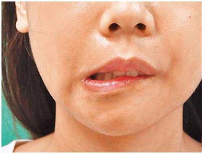 腦供血不足引發嘴角歪斜