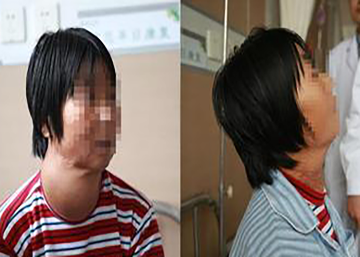 女性甲狀腺瘤手術切除對比