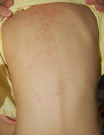 小兒急疹的症狀 (42) 