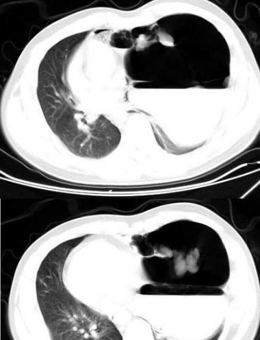 偶發房性早搏 (6) 