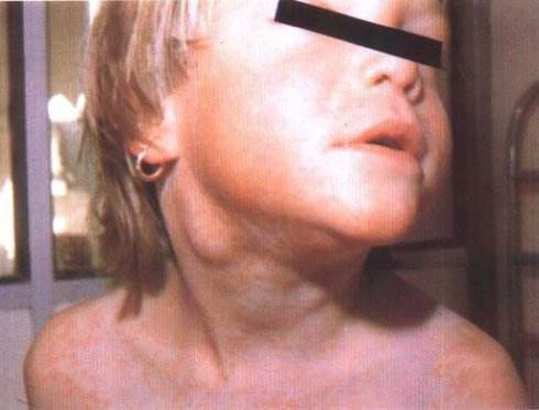 慢性淋巴結炎 (41) 