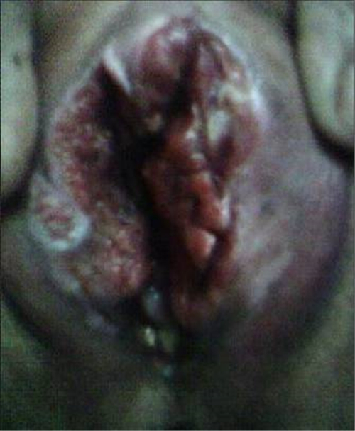 外陰癌早期症狀