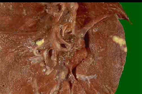 空洞型肺結核能活多久 (7) 