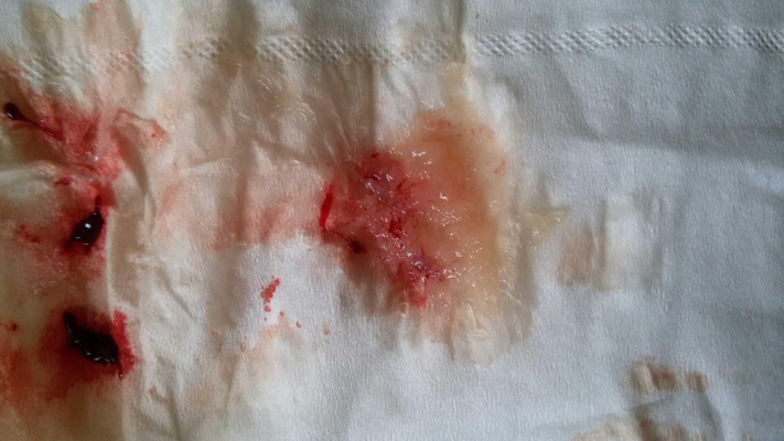 流產掉下來的孕囊