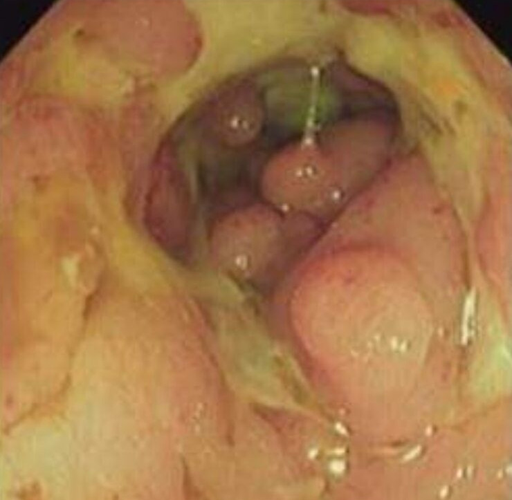 克羅恩病的鏡下的