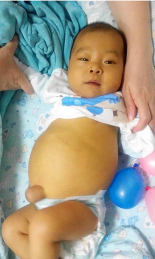 新生兒肝腹水症狀