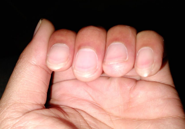 貧血指甲