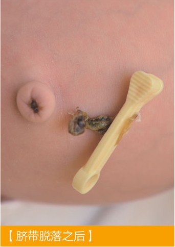 新生兒肚臍脫落圖 (6) 