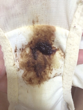 白帶帶有褐色分泌物 (59) 