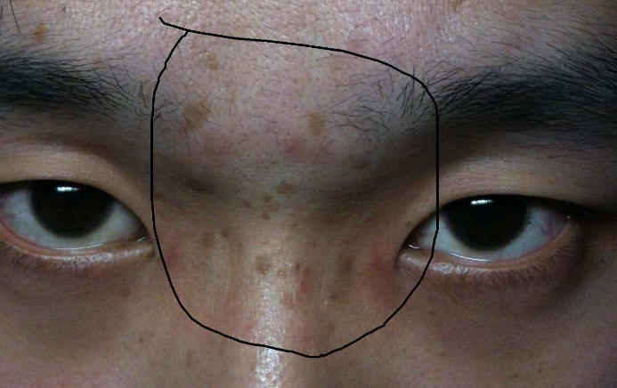 男人臉上長斑的