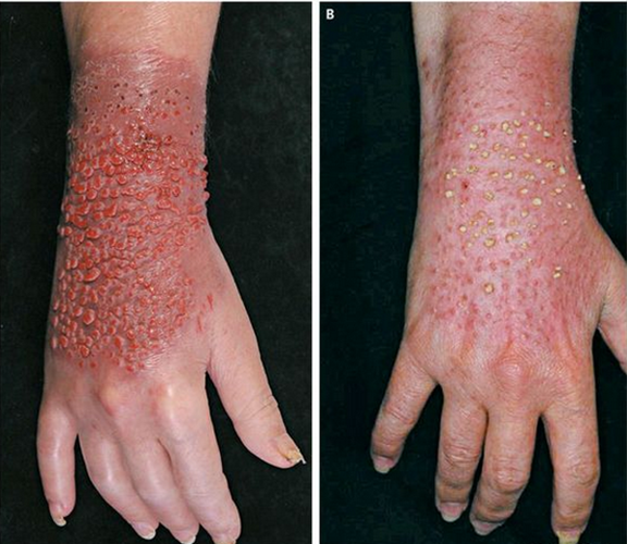 天花手部嚴重的