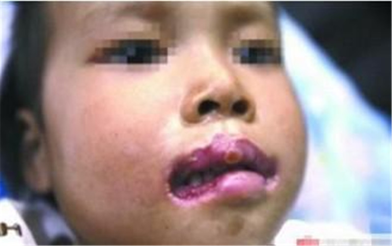 白塞病小孩患病