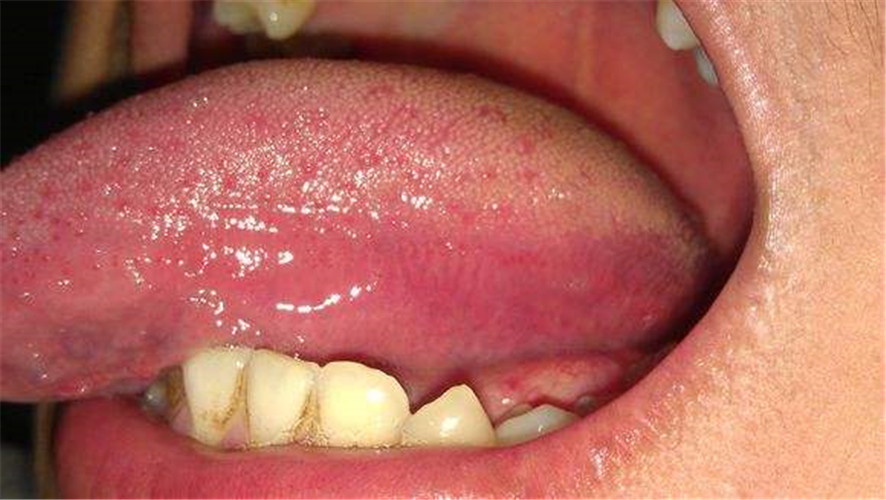 什麼引起白色念珠菌感染 